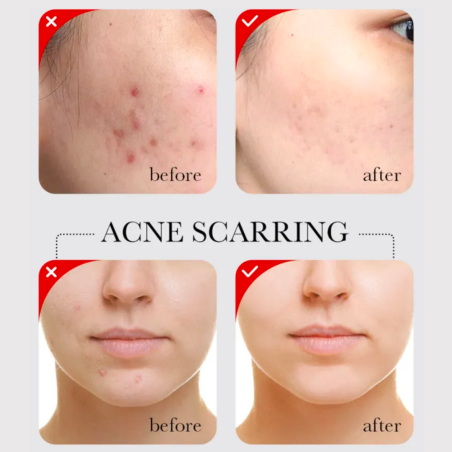 HEDELMÄHAPPOSEERUMI AHA + BHA