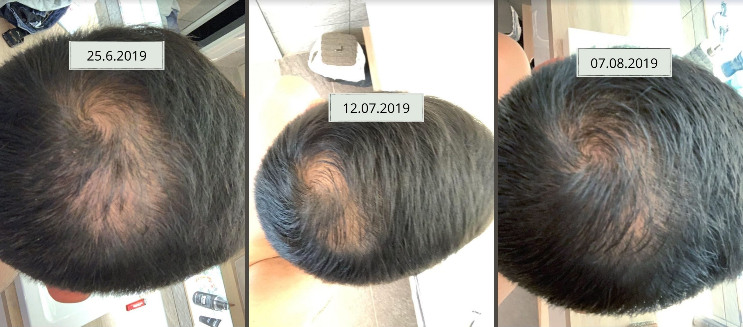 Hiusten hoitonesteellä saadut tulokset hiusten kasvuun